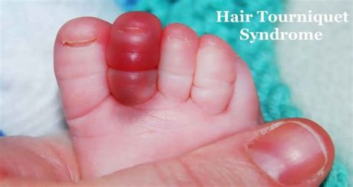 A hair tourniquet is when a strand of hair wraps around a body part and cuts off circulation. Photo / Instagram