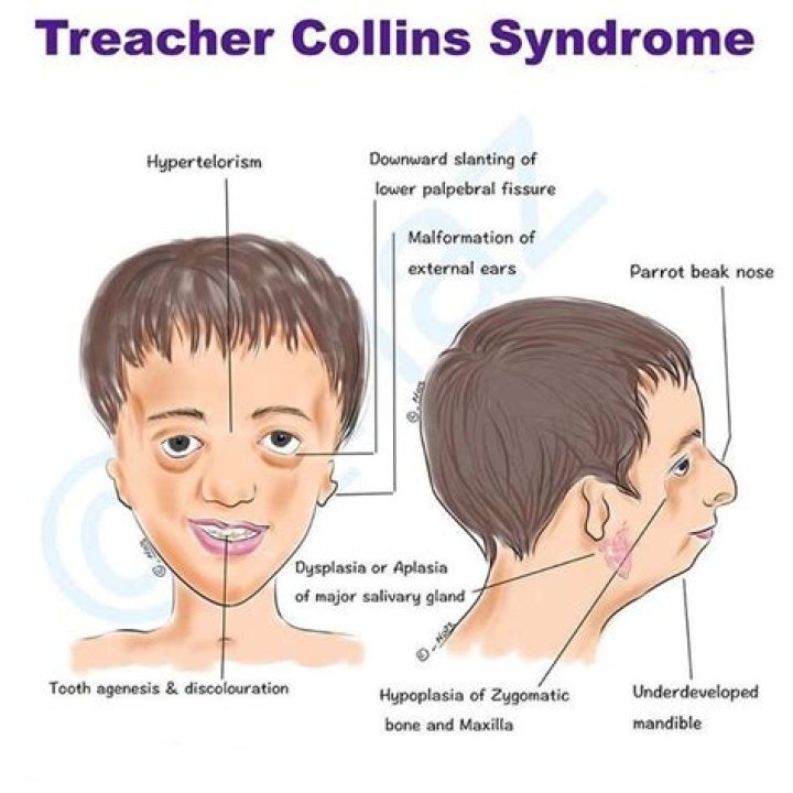 Author with Treacher Collins Syndrome Abandoned as a Baby, Now 'Full of
