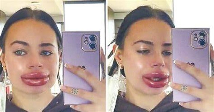 Botched lip filler injection nightmare for influencer Jessica Burko