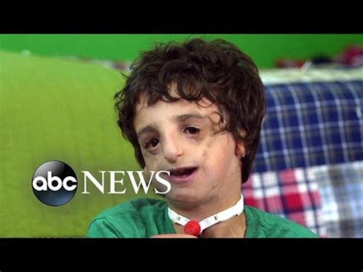 Boy living with Treacher Collins has 53 surgeries by age 11 20/20 Part