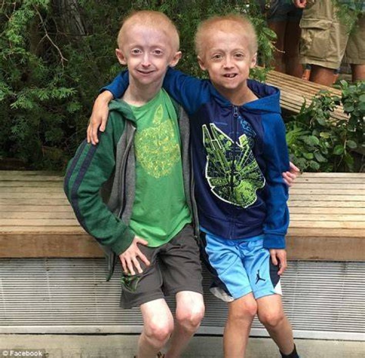 Brothers with rare 'Benjamin Button disease' have captured the hearts of millions