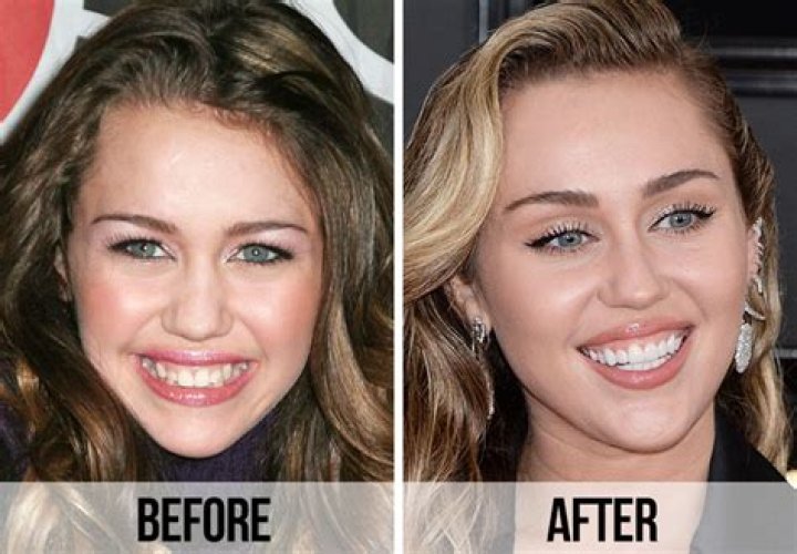 Celebrity veneers: Then and now photos of 30 biggest celebrity transformations Celebrity veneers: Then and now photos of 30 biggest celebrity transformations
