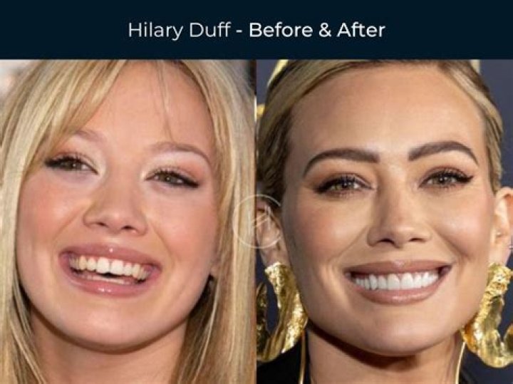 Celebrity veneers Celebrity veneers