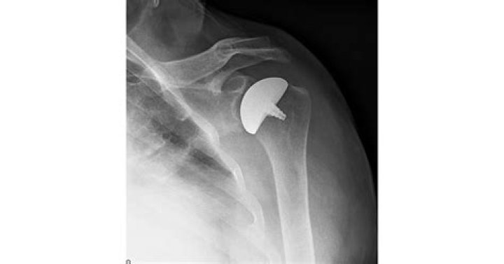 Clinical Study Demonstrates Equally Impressive Outcomes for Any Condition of Glenoid Using The Arthrosurface OVO® with Inlay Glenoid Total Shoulder
