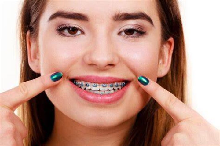 free braces cape town free braces cape town