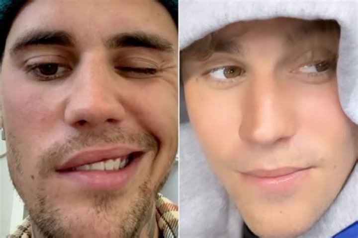 Justin Bieber Ramsay Hunt syndrome: Star gives update following diagnosis