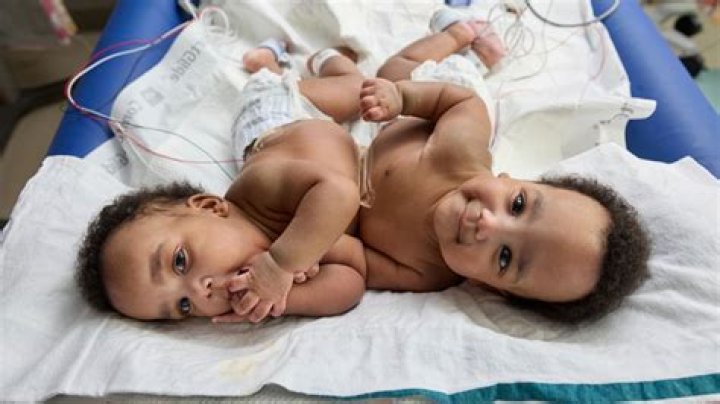 Limpopo Conjoined Twins Die a Week After Birth While in ICU After Their Health Took a Turn for the Worst