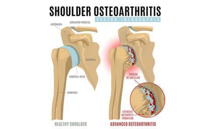 Shoulder Osteoarthritis (OA) treated with the nonspherical Arthrosurface OVO with Inlay Glenoid Arthroplasty System. New data demonstrates excellent clinical benefits, including pain relief and increased range of motion in patients with glenohumeral (GH) arthritis. Allows patients to resume an active lifestyle with no activity restrictions.