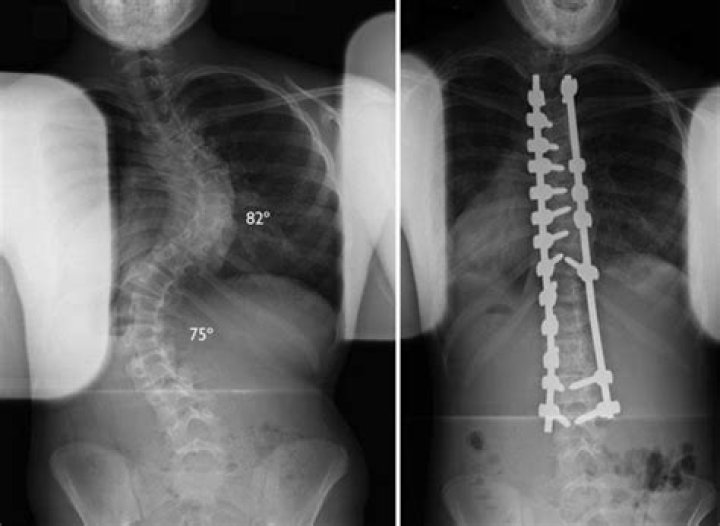 Surgical Treatment for Scoliosis OrthoInfo AAOS